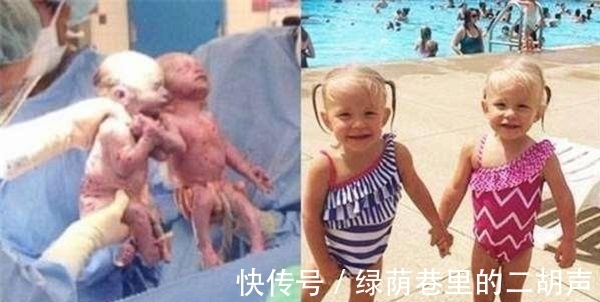 女婴|双胞胎手牵手一起出生,罕见的一幕,在场的医护人员都被暖化了