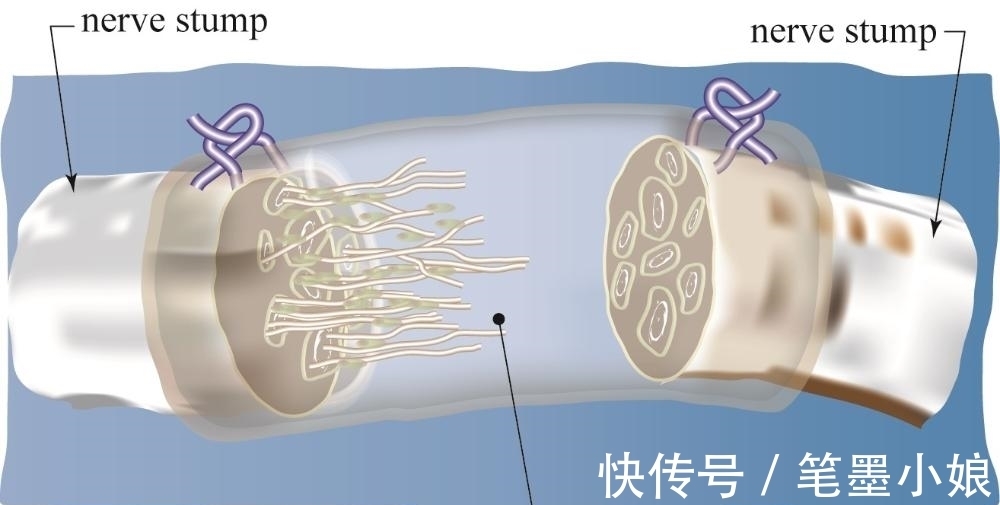 压力|科学家研发了现实版“无限手套”,能抓能感知,帮助肢体恢复功能