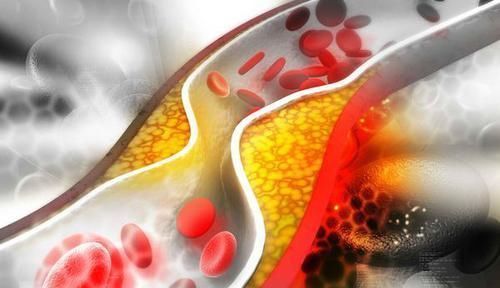 中老年人|血管堵塞,身体会有这5种感觉!早发现早检查,不能拖