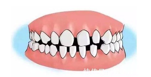 矫正|儿童做牙齿矫正三个最佳时间:家长要牢记,矫治越早干预效果越好