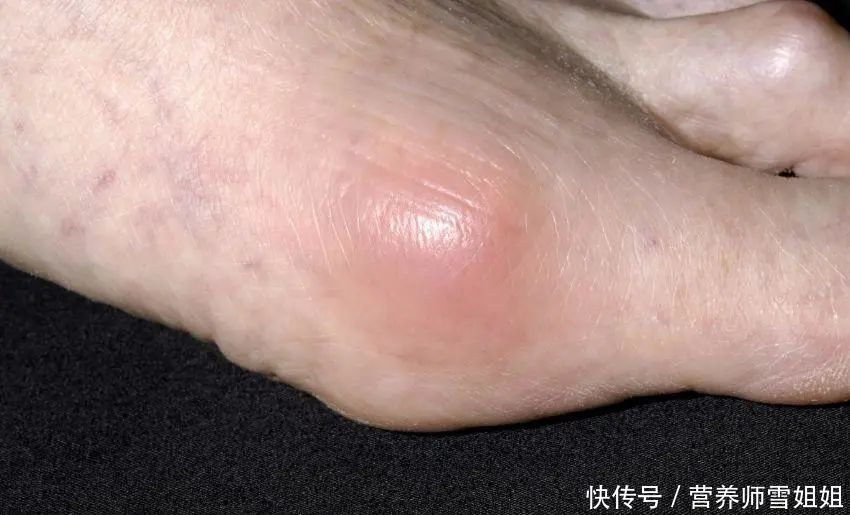 男到中年,不想痛风,少碰二物,做到三个坚决,