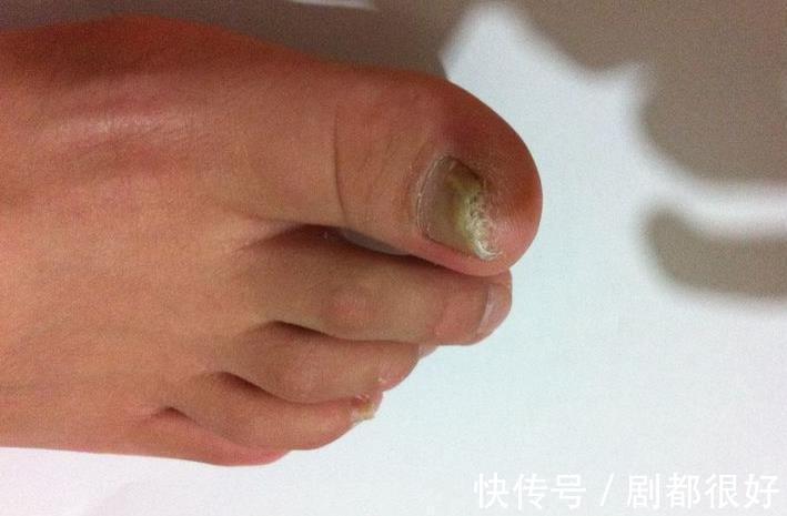 冬病夏治|80岁老中医:肾好不好,看脚就知道了,为健康早知早好!