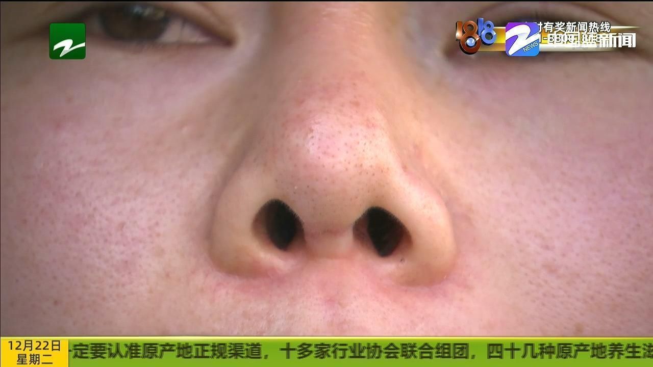 修复|修复后变“朝天鼻”“佰丽医美”已注销 对整形不满该怎么办?