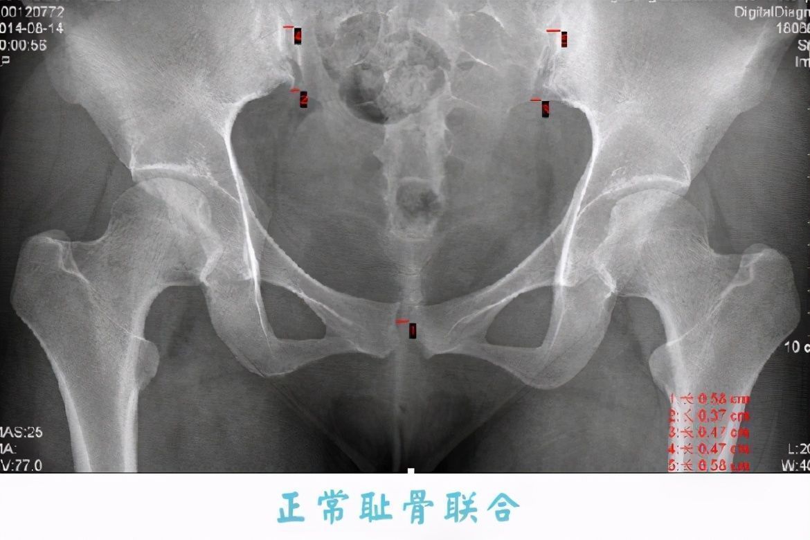 疼痛|“耻骨痛到厌世”，为何孕期会耻骨痛？原来是两块骨头在分离