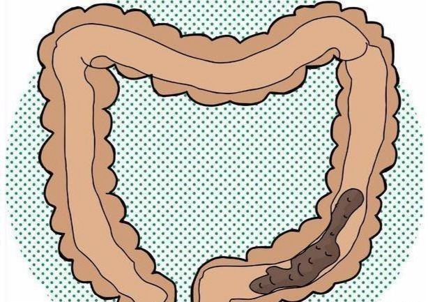 治疗|关于治疗便秘管用吗?