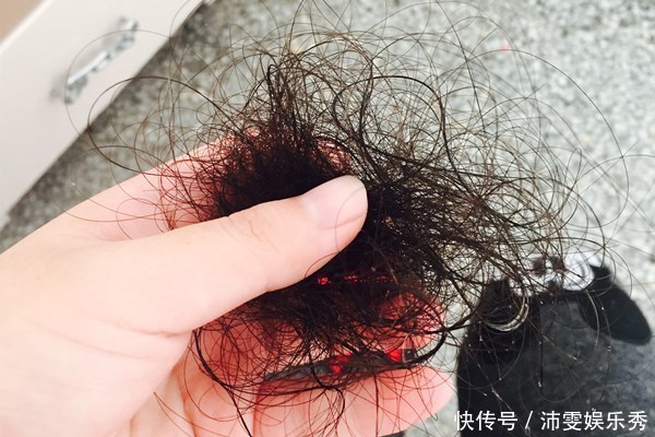 指甲|一挠头皮,指甲缝中都是白泥?医生:可能不是头皮屑,要上点心