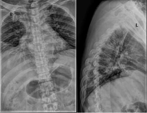 椎体|脊柱常见肿瘤及肿瘤样病变的几种影像学表现，你都见过吗？