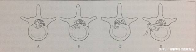 腰椎间盘突出的各种疗法！看这一篇就够了！