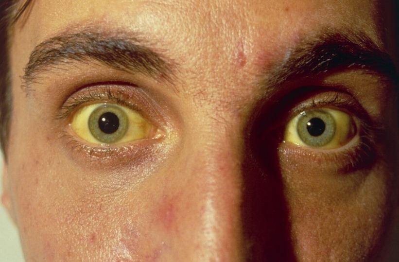 女孩|早餐一杯牛奶,25岁女孩确诊肝癌,医生惋惜:妈妈的宠溺害了她!