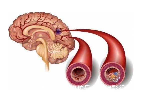 并发症|血脂高的人，多观察手指，若没这几个异常，说明脑梗离你还很远