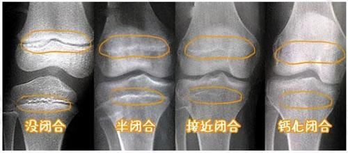 骨骺线|哪些因素会影响孩子长高，如何促进孩子长高？医生讲一讲