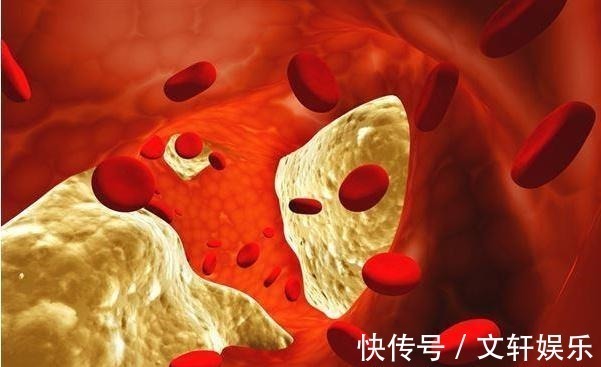 高血脂|晚上睡觉如果出现以下四种表现,八成是血脂过高,及时去医院检查