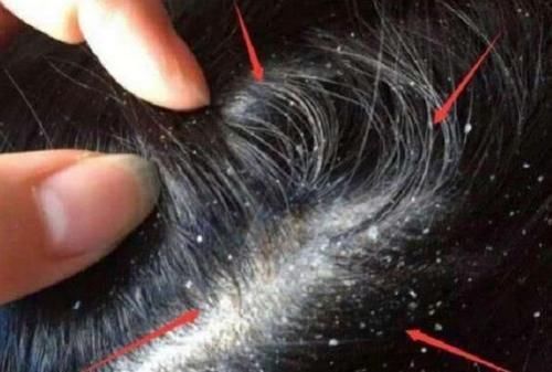 头上抠出白色“颗粒物”？到底是什么？通常离不开“3个原因”！