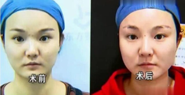 女子 女子花2万元整容,结果脸部肿成猪头,医院:这属于正常情况