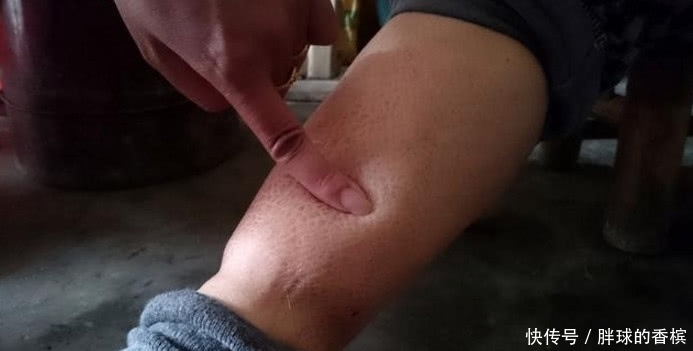标记|尿酸开始升高时,身体有3种标记,若1个不占,肾结石离你还很远
