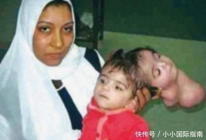 畸形|刚出生的双婴儿“第二个宝宝头颅”长在肚子上,心疼妈妈跟宝宝