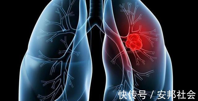 根治性|明明是肺癌早期做了根治性手术,不久就复发转移了,到底什么原因