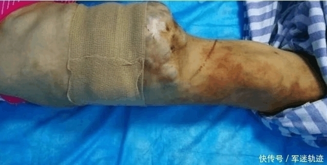 医生们|女孩大腿异常肿痛流血不止, 检查结果连医生都吓了一跳