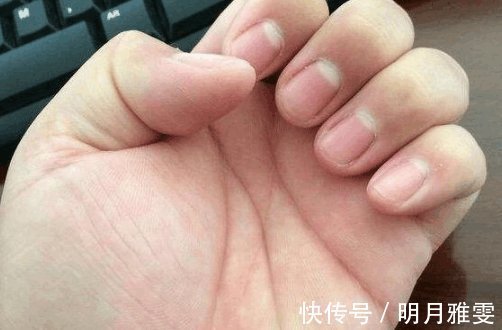 甲状腺功能|指甲上一个月牙都没有 别胡乱猜测了, 主要跟这几点有关!