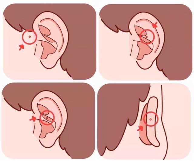文文|为什么有些孩子耳朵会有“小孔”医生一般不说,父母心里要有数