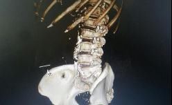 梁阿婆|广州阿婆自行针灸，不料针断腹中！