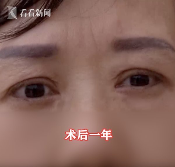 老公|女子花2万割双眼皮3个月没消肿 老公要离婚