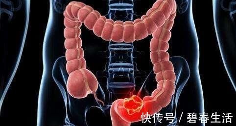 火龙果|长期便秘会不会患肠癌?医生:常吃6物,“踢走”老便秘