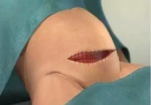 伟大|剖腹产不就是“划肚取胎”组图揭秘全过程，看完才懂母亲的伟大