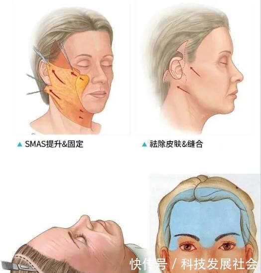 筋膜 关于拉皮手术的16个真相,很多人都不知道真假!