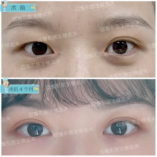 逼疯强迫症的一单一双眼皮，手术能不能只做单侧？