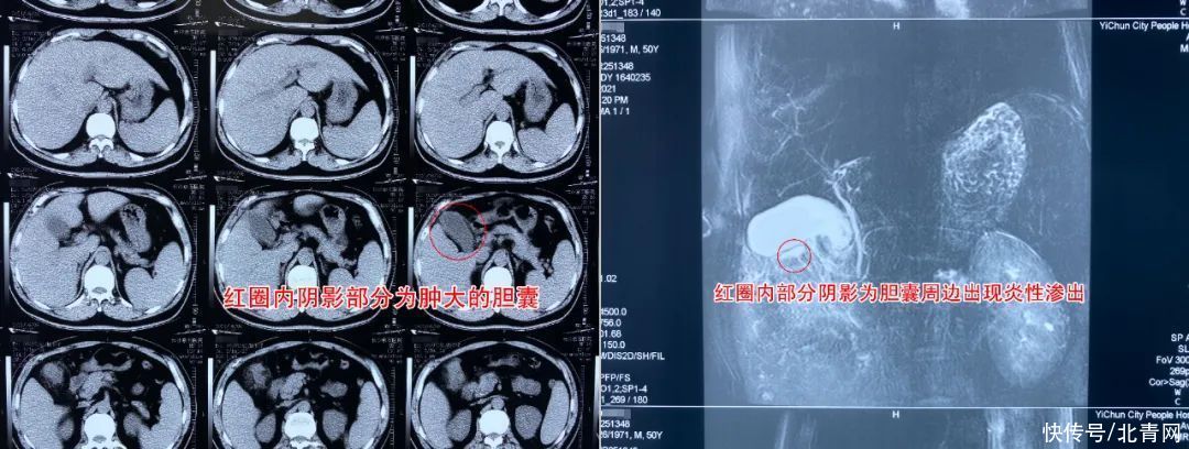 长沙京石结石医院|男子频繁腹痛患胆结石致胆囊穿孔：痛到内脏都受不了