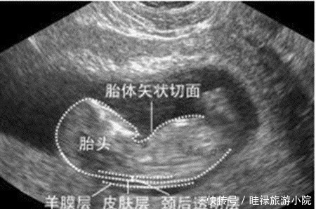 医生|孕期产检不想生个“傻孩子”,这三项产检必须按时做,不能忽视