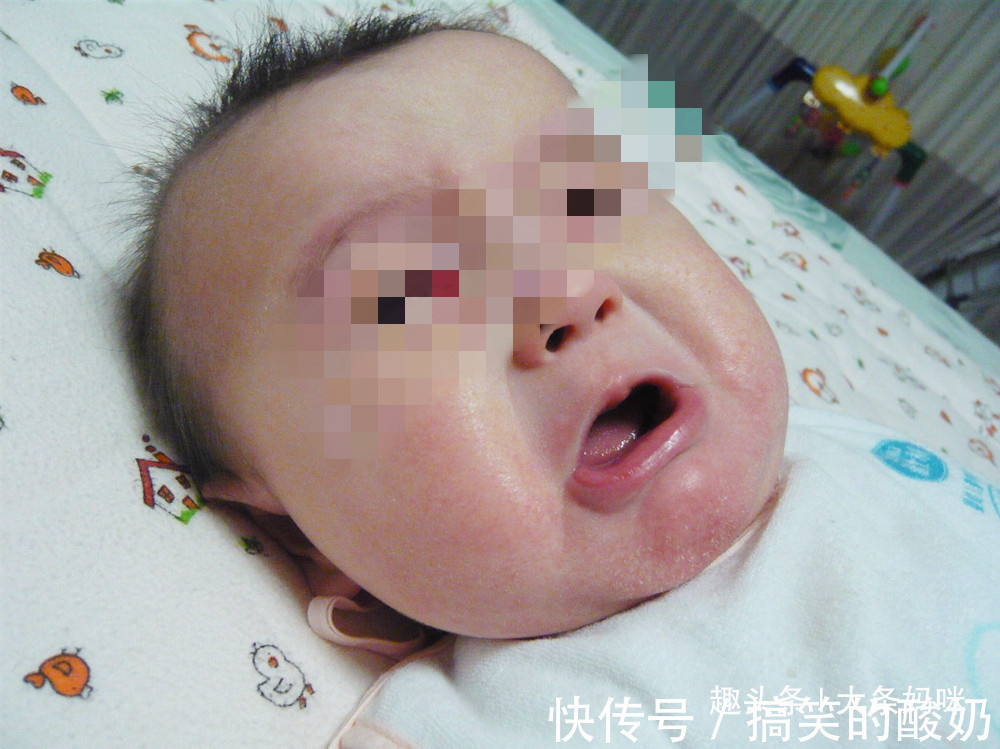 婴幼儿|十个妈妈九个愁,恼人的婴幼儿湿疹,到底应该怎么“破”