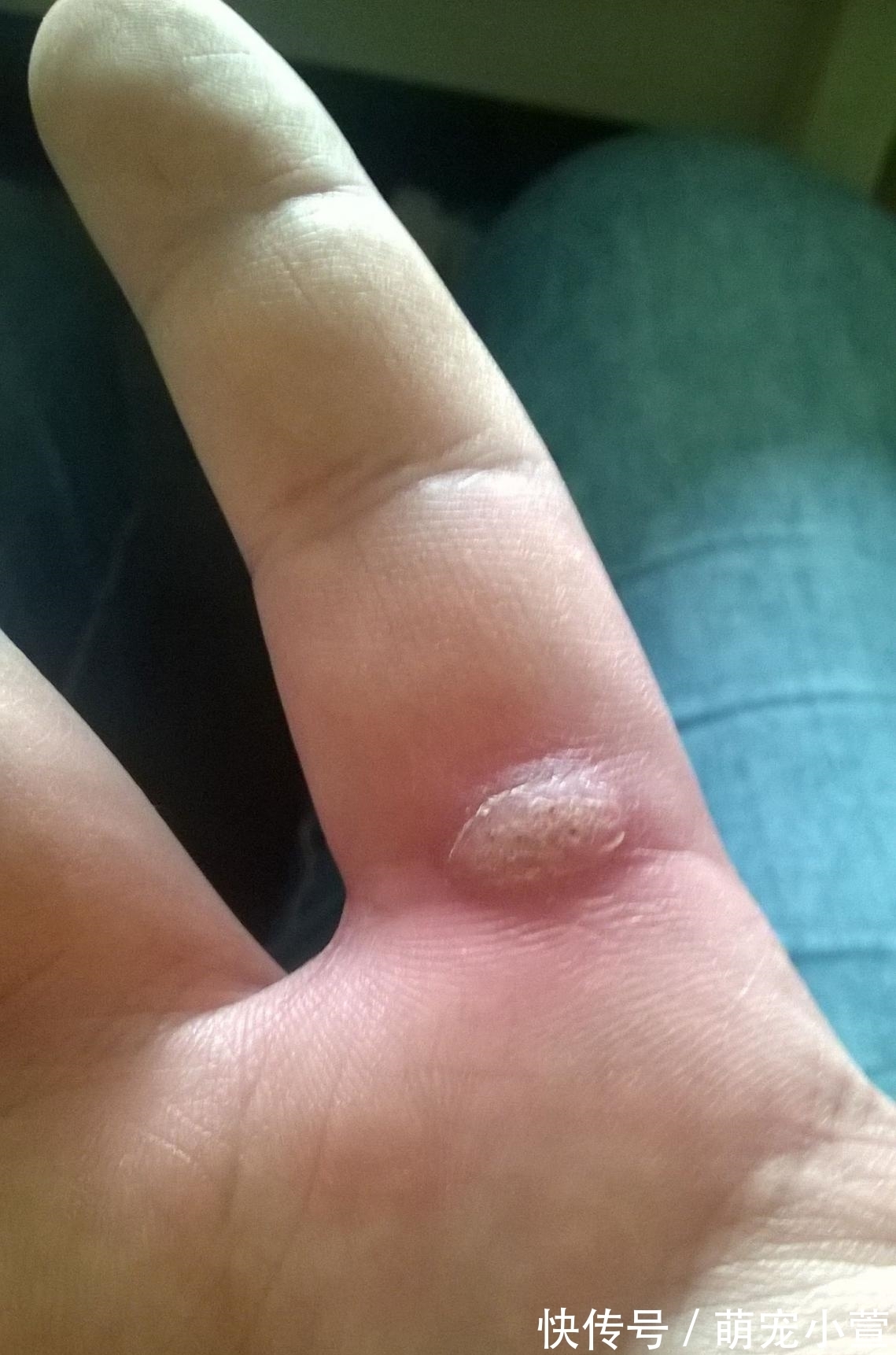 上门|90后情侣感染hpv,医生提醒:男女身上2处“长痘”,或是hpv找上门