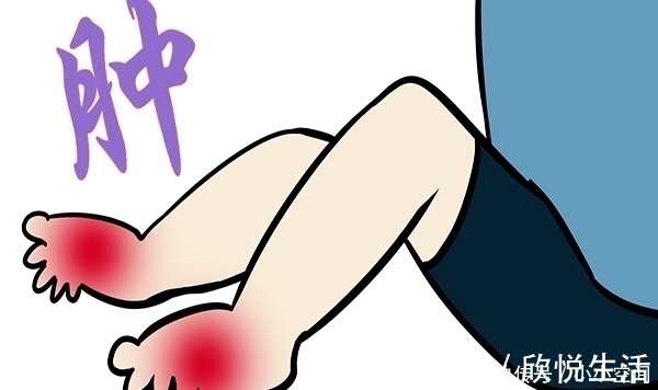 异常|糖尿病患者中，3类人可能易患肾病，出现4种异常，得预防尿毒症