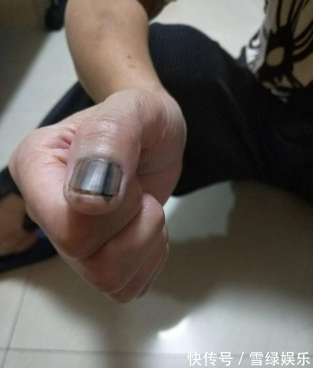 癌症|指甲上有黑线，可能是最恶的癌症，医生教你怎么办