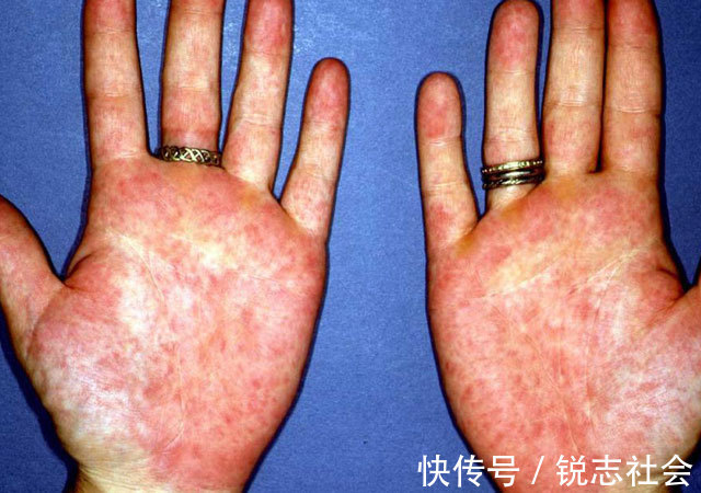 指甲|肝炎加重了伸开双手就知道,3变化及时检查,取冰箱2物养好肝