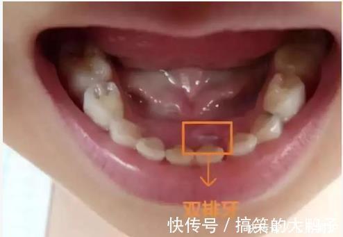 双排牙|6岁孩子长出双排牙,赶紧带去医院检查,得知原因宝妈后悔不已