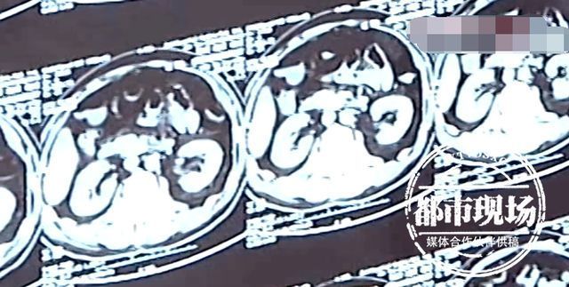 手术治疗|男孩呕吐、高烧送进医院!医生:肚子里“藏”了玩具