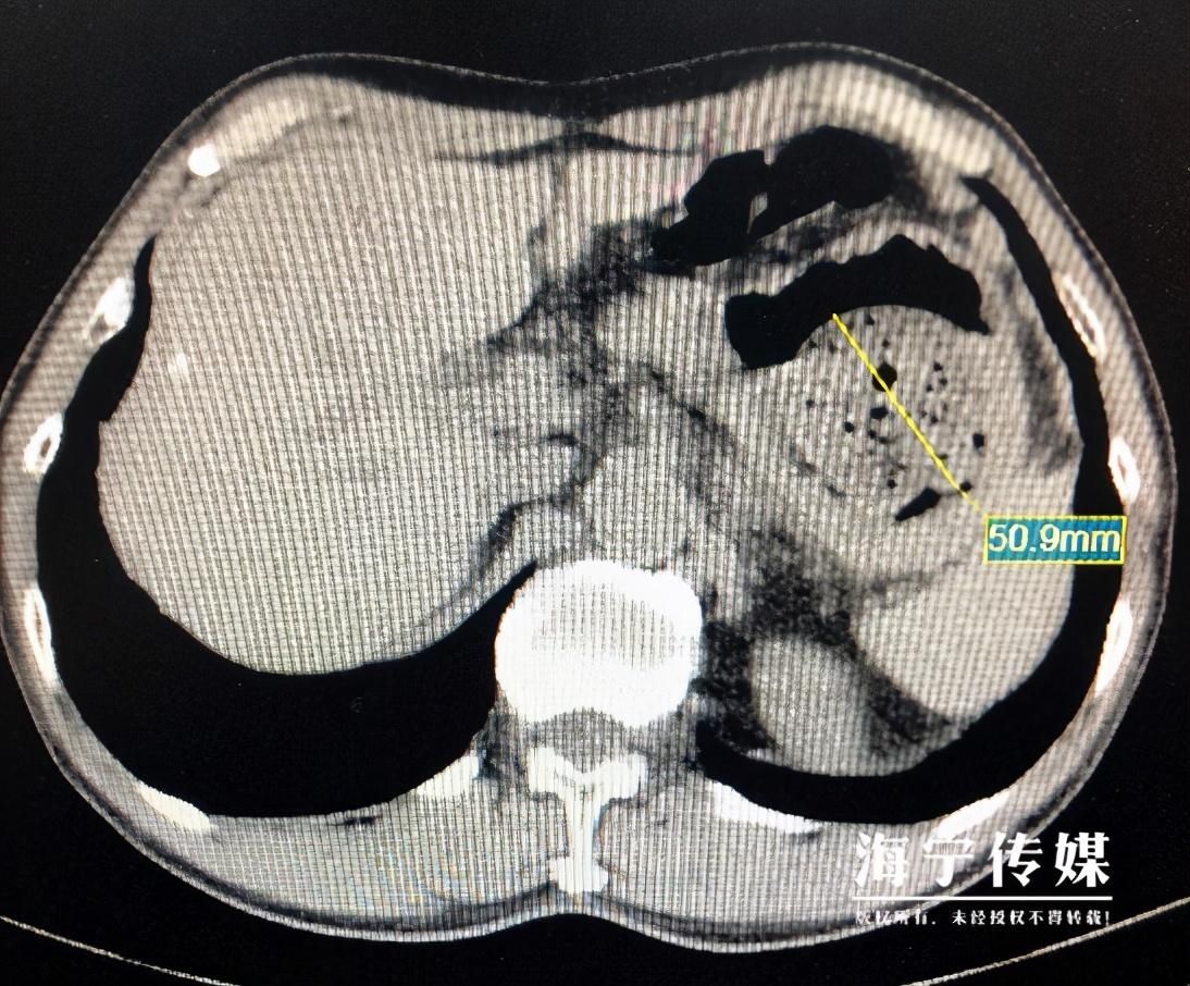 巨石|男子吃水果长出“金色巨石”，整个拳头那么大！治疗一波三折