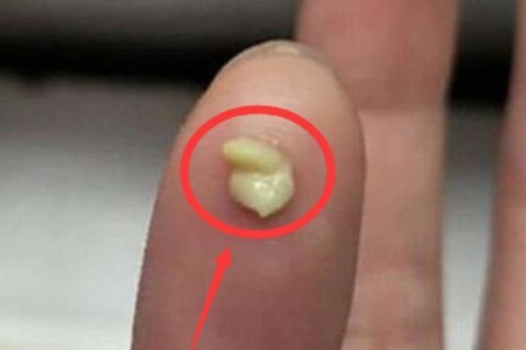 信号|嘴里的“米粒”,是身体发出的“求救信号”,大部分人嘴里都有