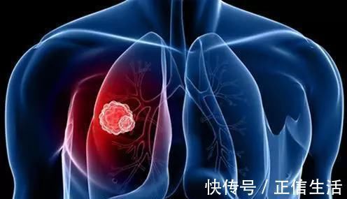 乳腺癌|钙化是癌变的信号和哪些癌症息息相关呢