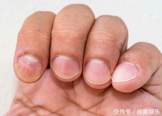 表现|肝不好手上一旦出现4种表现,是肝脏在求救,别不当回事