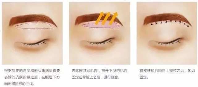 切眉术