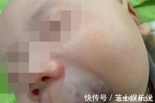 症状|宝宝脸上是海绵状血管瘤吗?家长只要看是否出现这些症状