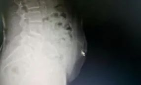软组织感染|这事儿真不能做！阿婆在家自己扎针灸，结果针断进腹中