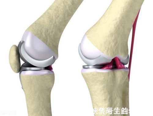 关节|得了膝关节炎,打玻璃酸钠到底管不管用?骨科医生告诉你答案