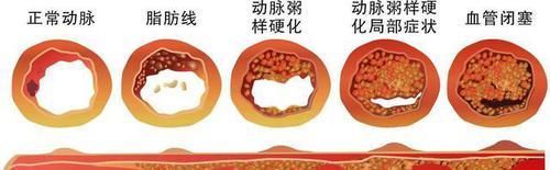  来临|血栓来临，身体可能出现这6个“变化”，有没有？不妨对比一下