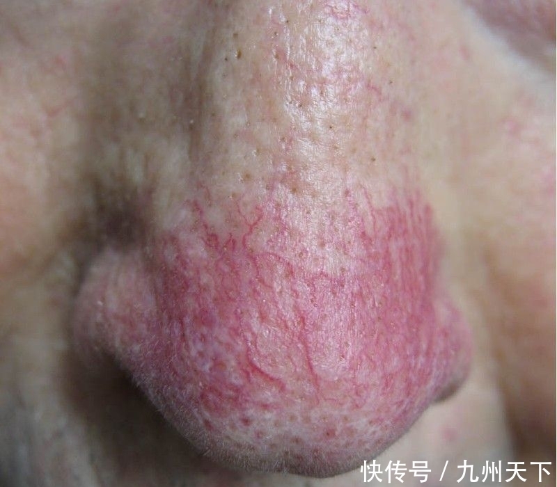 种菜|中医:肥胖引发脂肪肝,多喝1种汤,多吃1种菜,肚子慢慢消
