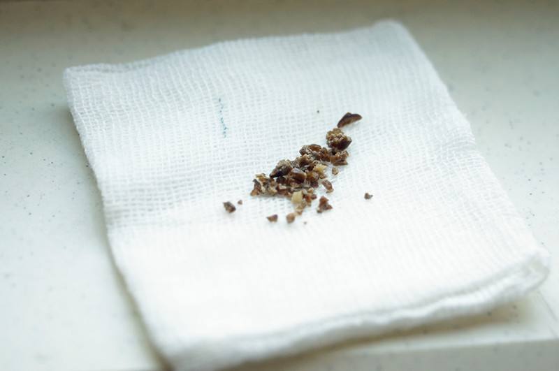 方子|气通了,结石就掉下来了!老中医拿出一张方子,说明一切